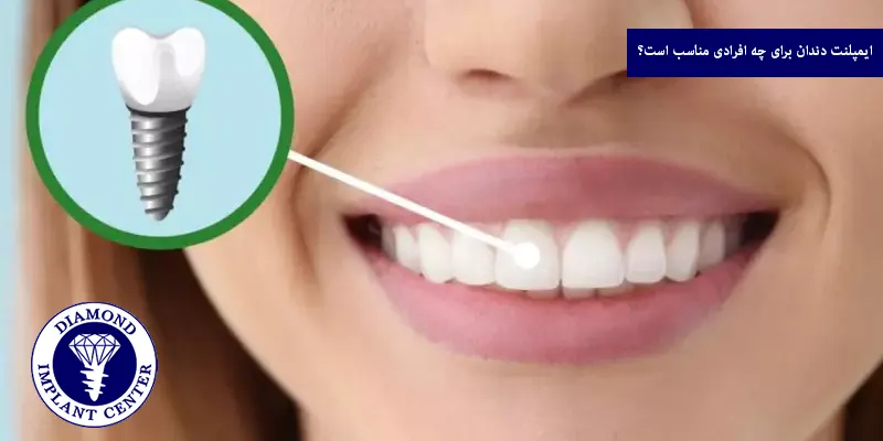 ایمپلنت دندان برای چه افرادی مناسب است؟