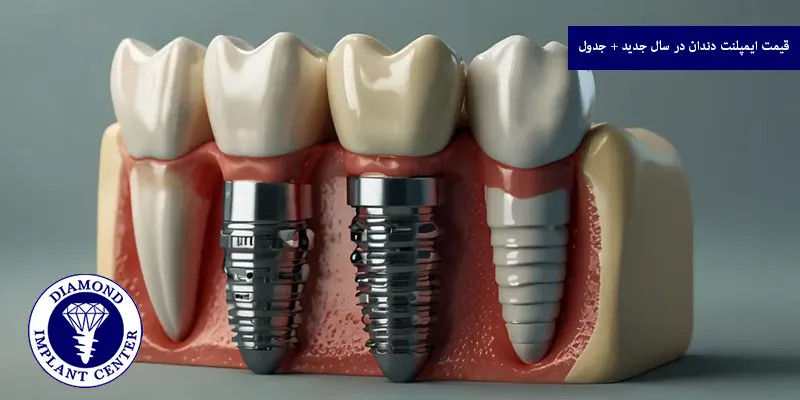 قیمت ایمپلنت دندان در سال ۱۴۰۴ + جدول