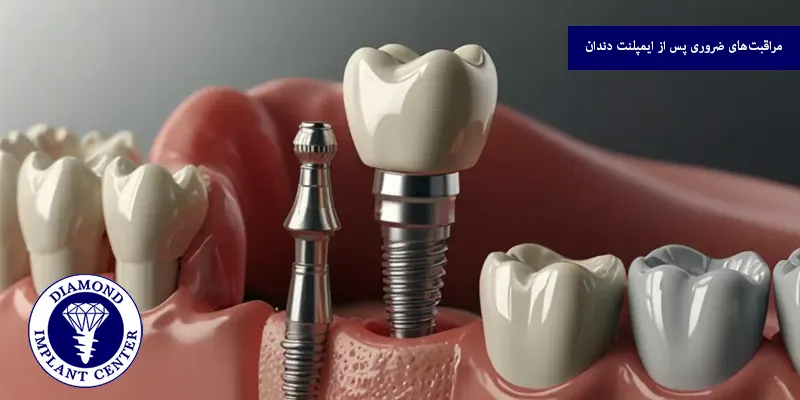 مراقبت‌های ضروری پس از ایمپلنت دندان
