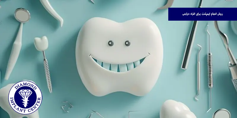 روش انجام ایمپلنت برای افراد دیابتی