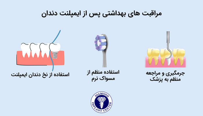 مراقبت های بعد از ایمپلنت دندان در بلند مدت
