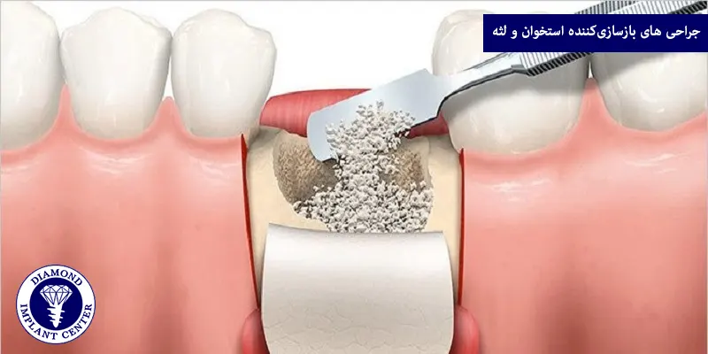 جراحی‌ های بازسازی‌کننده استخوان و لثه