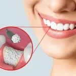جراحی‌های بازسازی‌کننده استخوان و لثه
