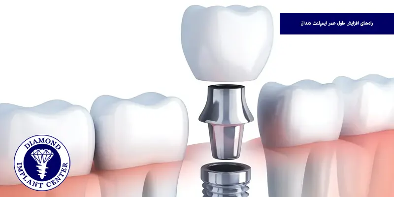 راه‌های افزایش طول عمر ایمپلنت دندان