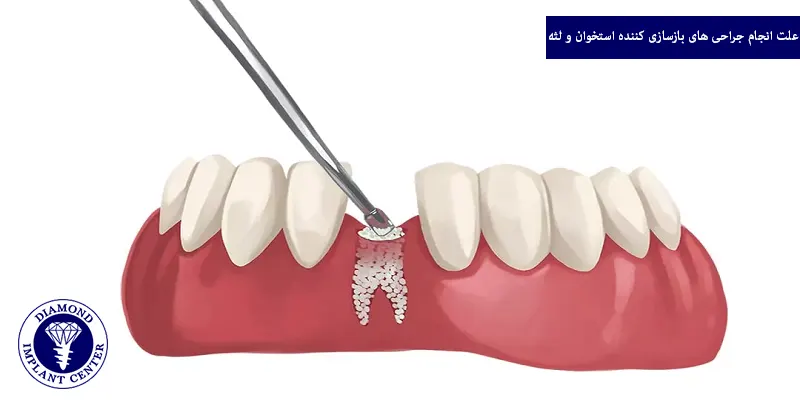 علت انجام جراحی های بازسازی کننده استخوان و لثه