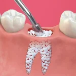 پیوند استخوان برای ایمپلنت