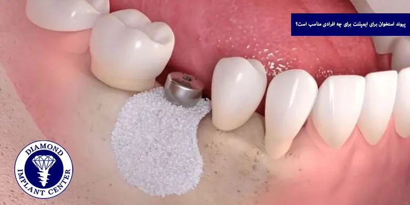 پیوند استخوان برای ایمپلنت برای چه افرادی مناسب است؟