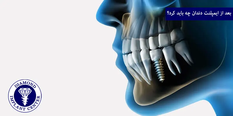 بعد از ایمپلنت دندان چه باید کرد؟