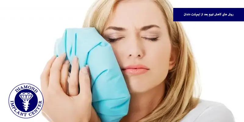 روش های کاهش تورم بعد از ایمپلنت دندان