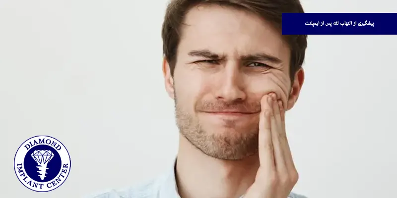 پیشگیری از التهاب لثه پس از ایمپلنت