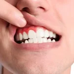 تحلیل لثه پس از ایمپلنت