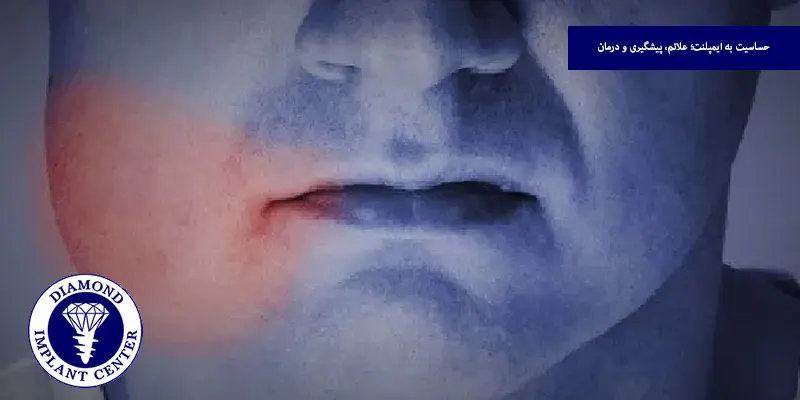 حساسیت به ایمپلنت؛ علائم، پیشگیری و درمان