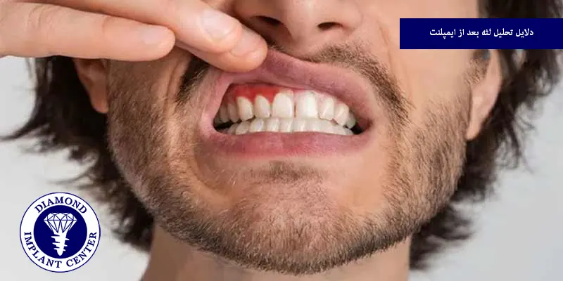 دلایل تحلیل لثه بعد از ایمپلنت