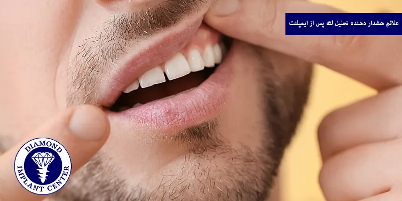 علائم هشدار دهنده تحلیل لثه پس از ایمپلنت