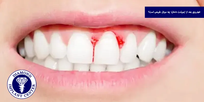 خونریزی بعد از ایمپلنت دندان؛ چه میزان طبیعی است؟