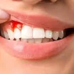 خونریزی پس از ایمپلنت