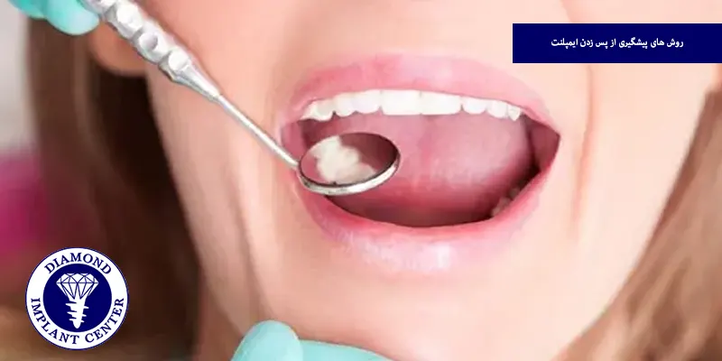 روش های پیشگیری از پس زدن ایمپلنت