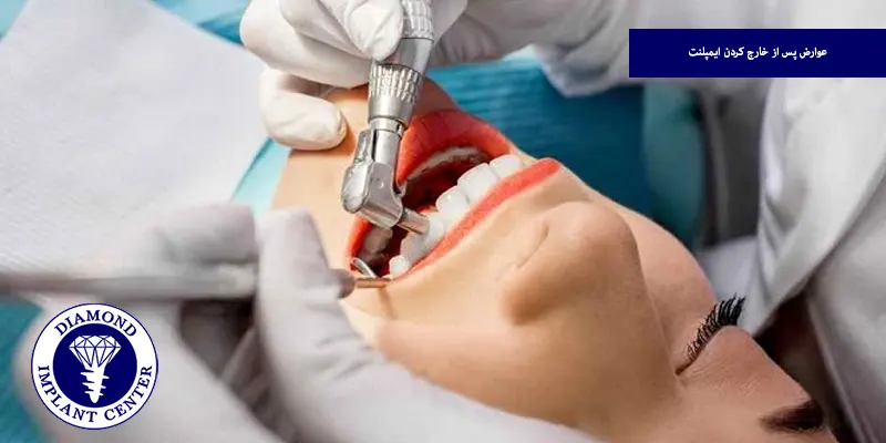 عوارض پس از خارج کردن ایمپلنت