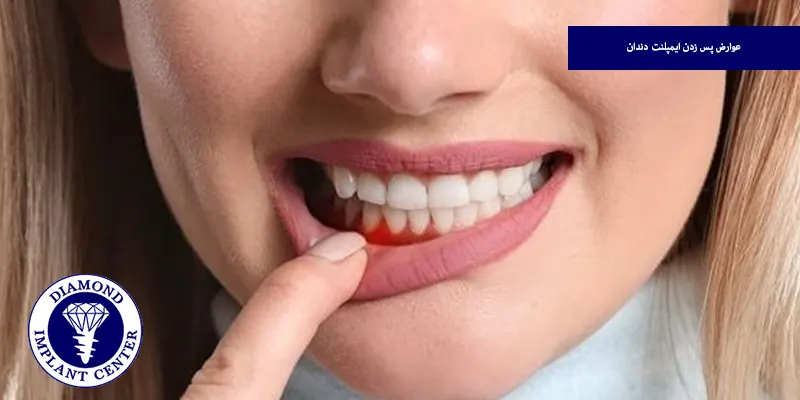 عوارض پس زدن ایمپلنت دندان