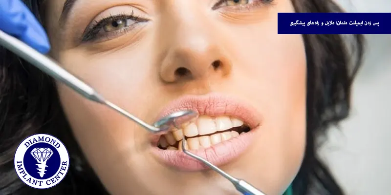 پس زدن ایمپلنت دندان؛ دلایل و راه‌های پیشگیری