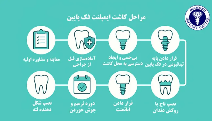 مراحل جراحی ایمپلنت فک پایین