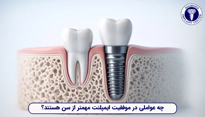 عوامل موثر بر سن مناسب ایمپلنت دندان