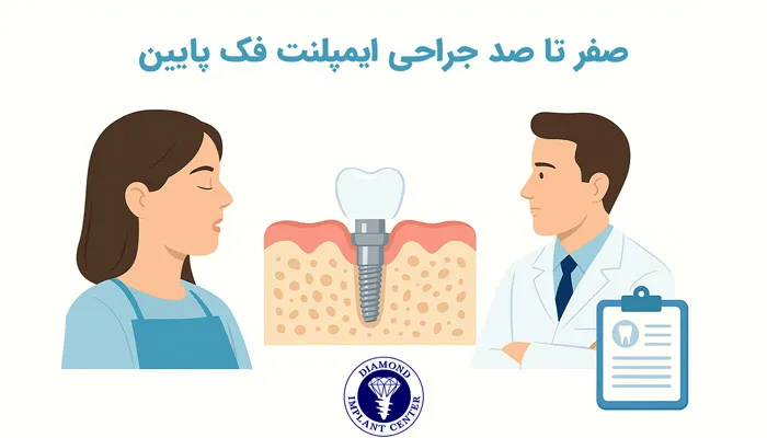 جراحی ایمپلنت فک پایین + مراحل انجام و هزینه