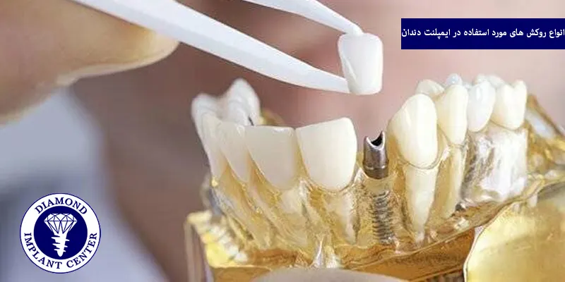 انواع روکش‌ های مورد استفاده در ایمپلنت دندان