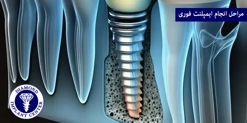 مراحل انجام ایمپلنت فوری