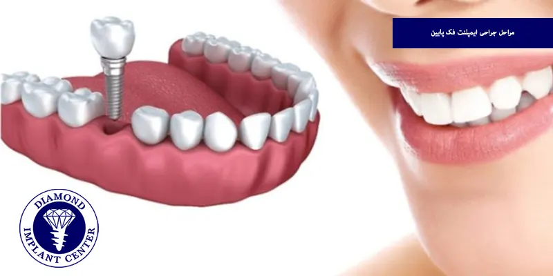مراحل جراحی ایمپلنت فک پایین