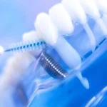 تمیز کردن ایمپلنت دندان به چه صورت است؟
