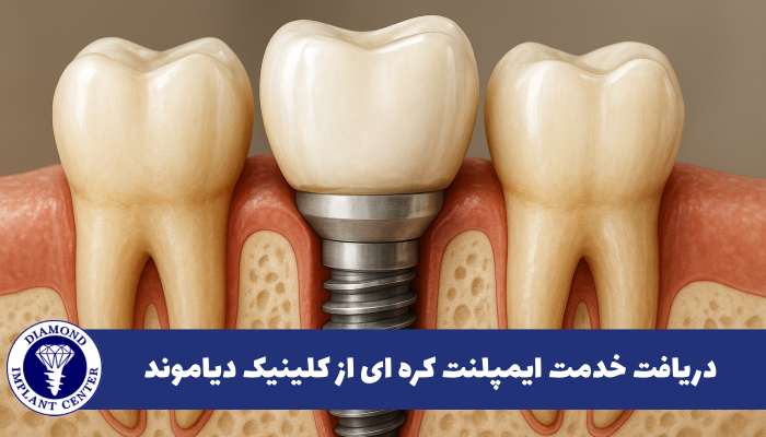 هزینه ایمپلنت کره ای