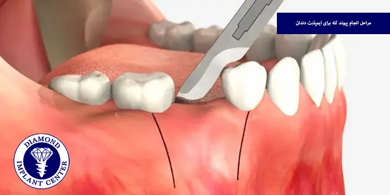 مراحل انجام پیوند لثه برای ایمپلنت دندان