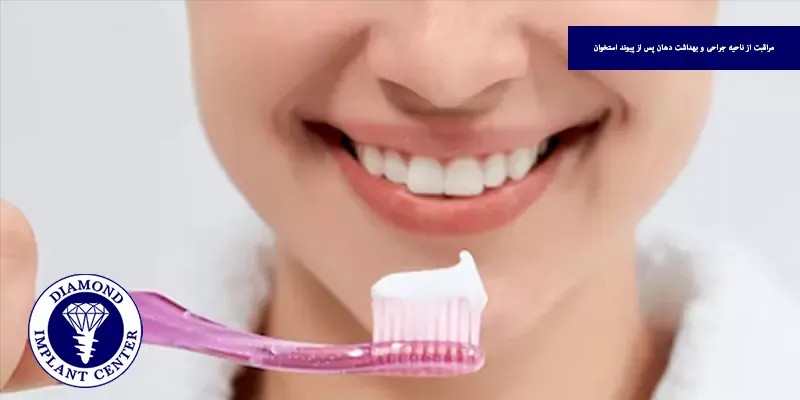 مراقبت از ناحیه جراحی و بهداشت دهان پس از پیوند استخوان