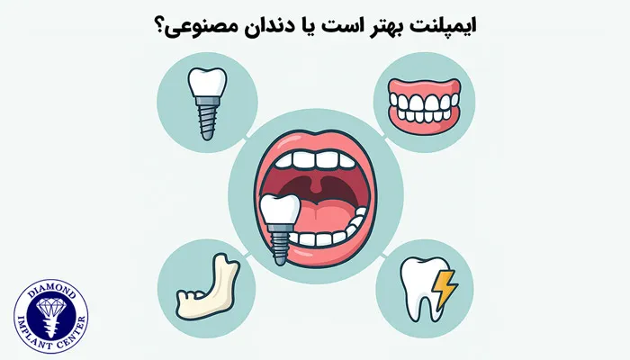 ایمپلنت و دندان مصنوعی چه فررقی با هم دارند؟