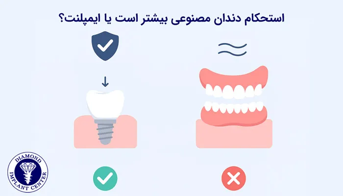 آیا استحکام ایمپلنت بیشتر از دندان مصنوعی است؟