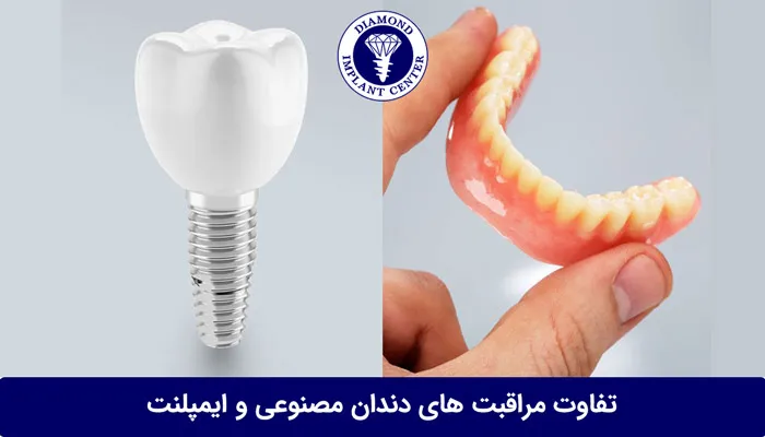 تفاوت ایمپلنت و دندان مصنوعی در مراقبت