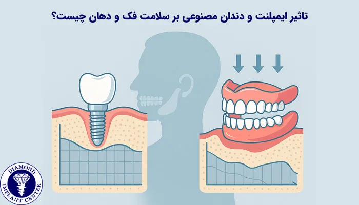 تأثیر ایمپلنت بر سلامت دهان و فک