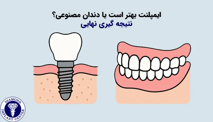 دندان مصنوعی بهتر است یا ایمپلنت دندان؟