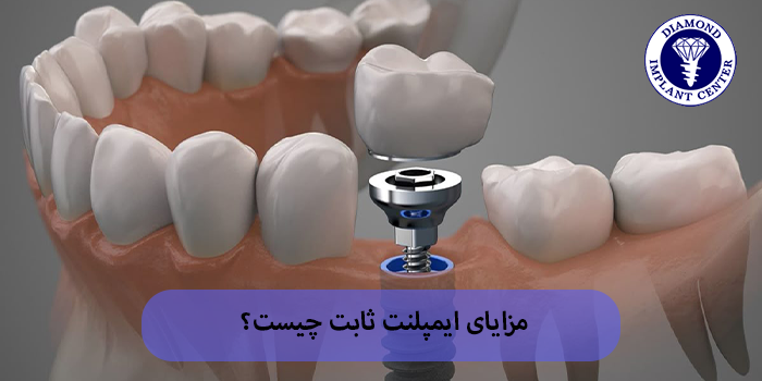 مزایای ایمپلنت ثابت چیست؟