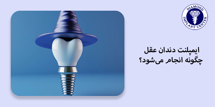ایمپلنت دندان عقل