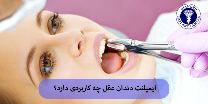 مراحل کاشت ایمپلنت دندان عقل