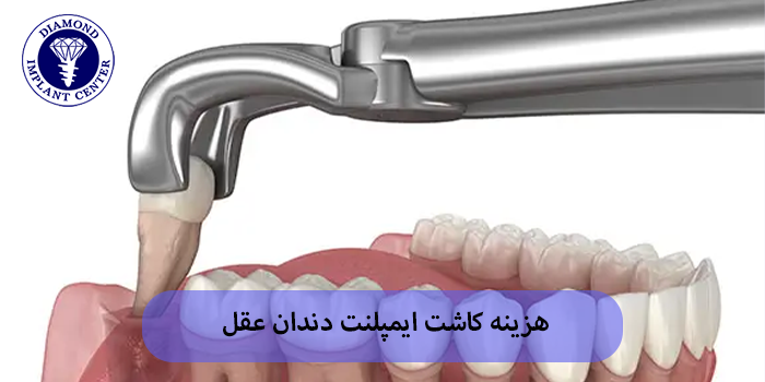 هزینه کاشت ایمپلنت دندان عقل
