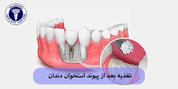 تغذیه بعد از پیوند استخوان دندان
